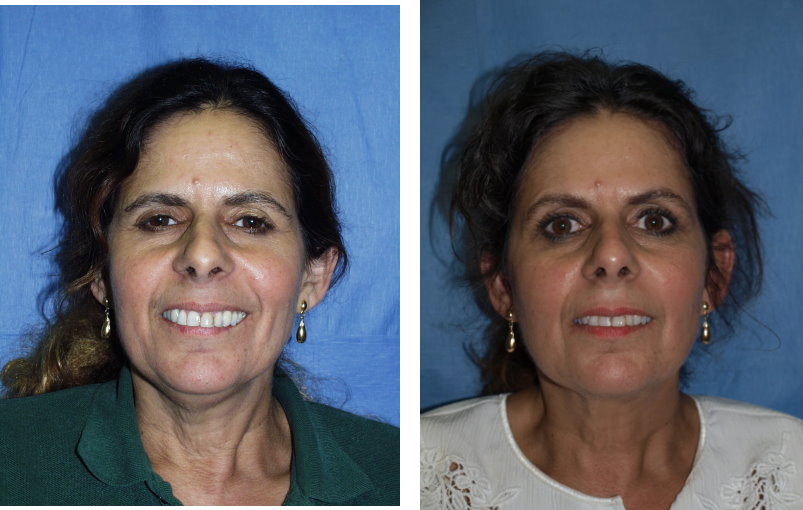Temporal Brow lift (Before & After)