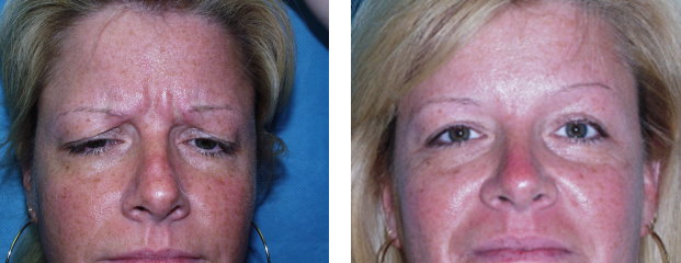 Blepharoplasty (upper) Before & After