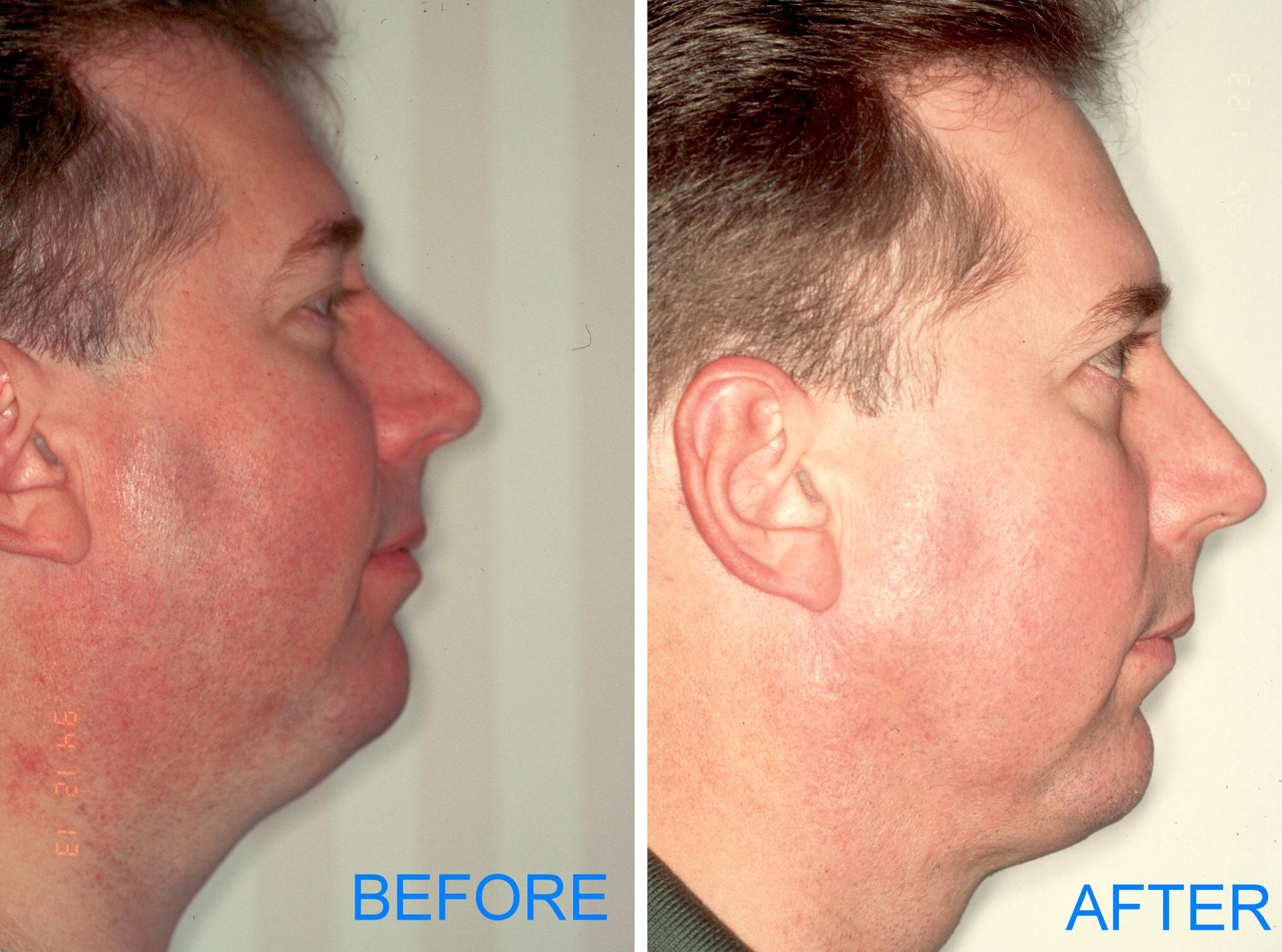 Neck Liposuction 