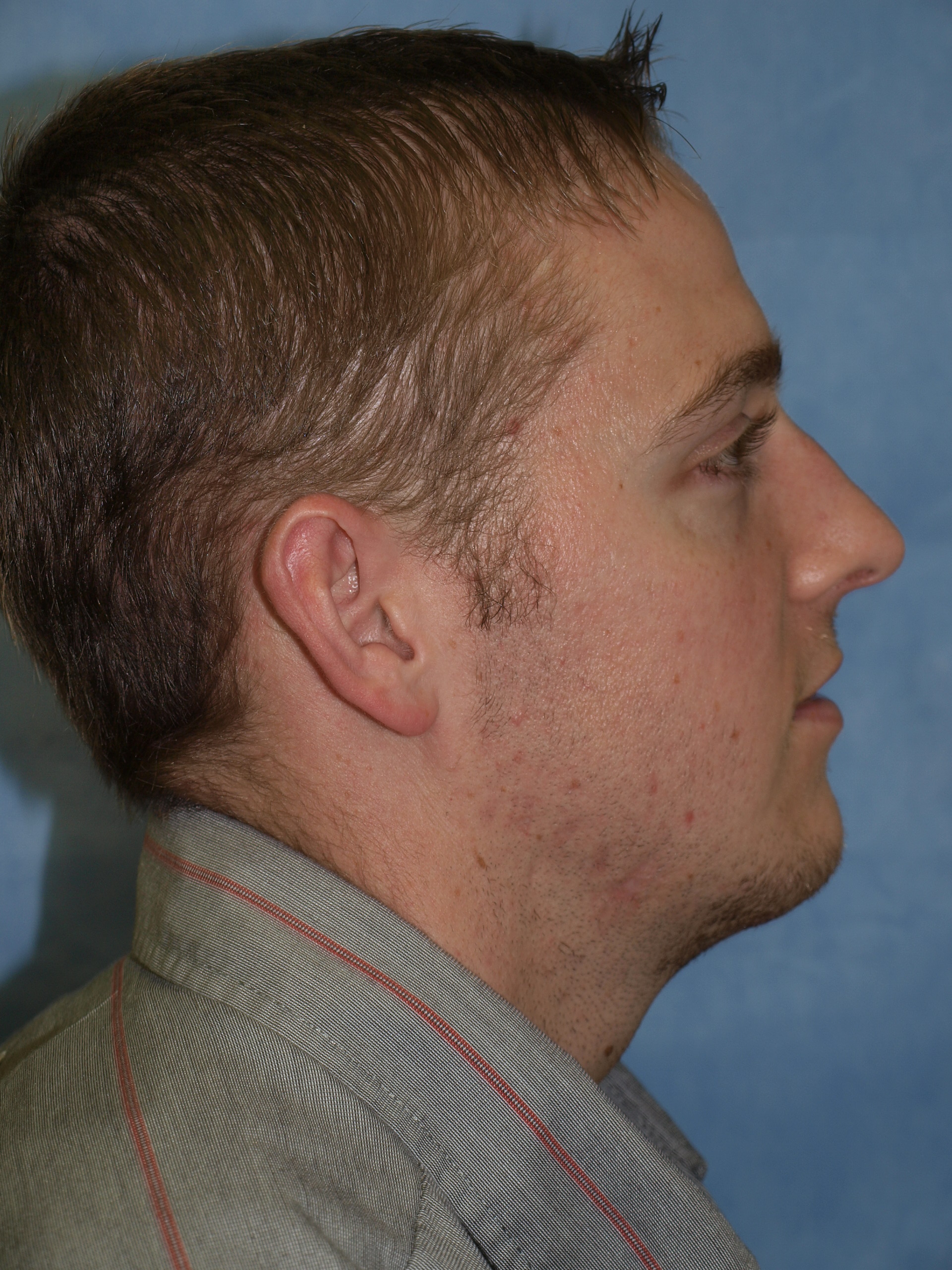 Chin Implant ( Lateral, After)