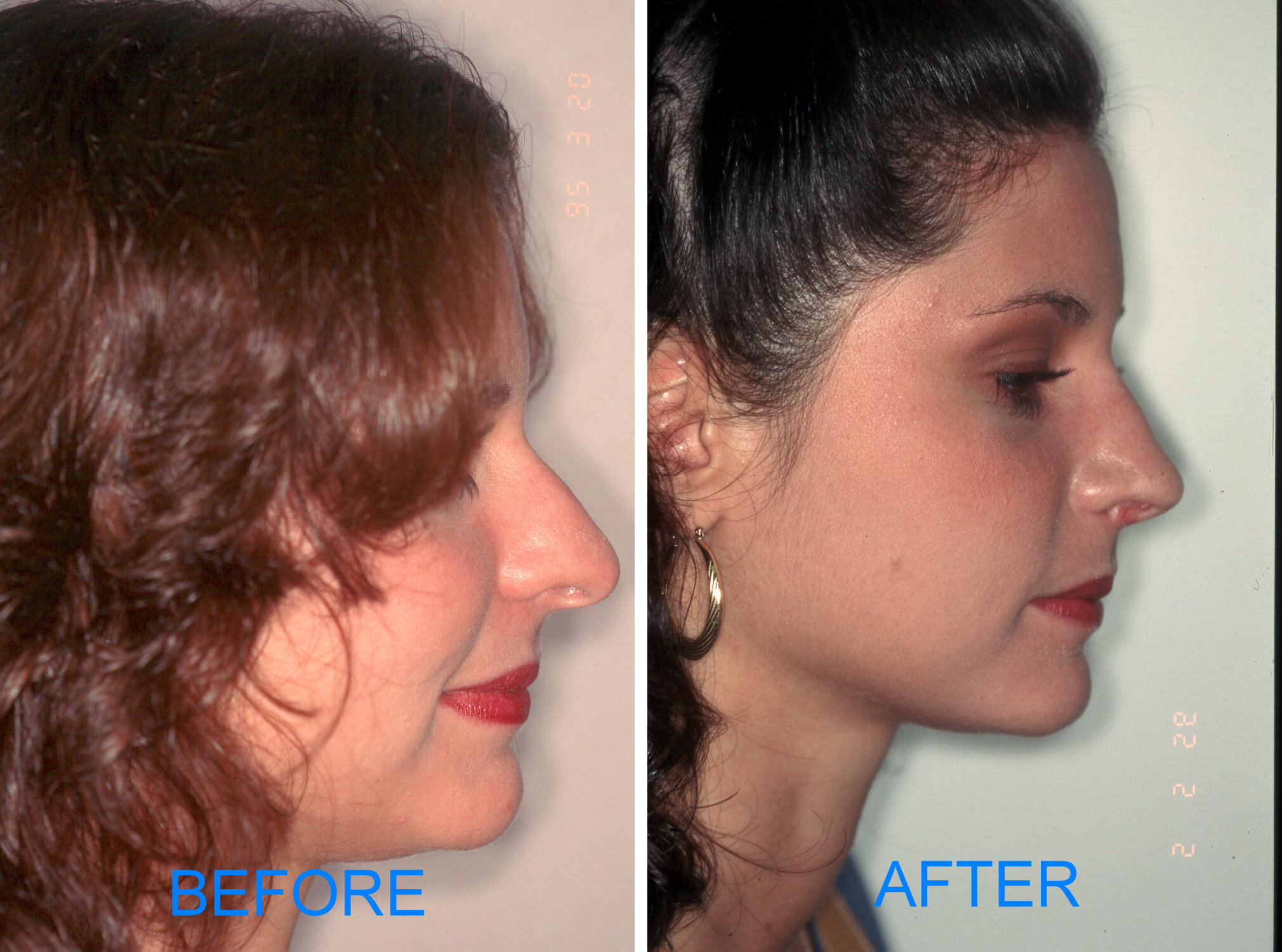 Rhinoplasty (Before & After)