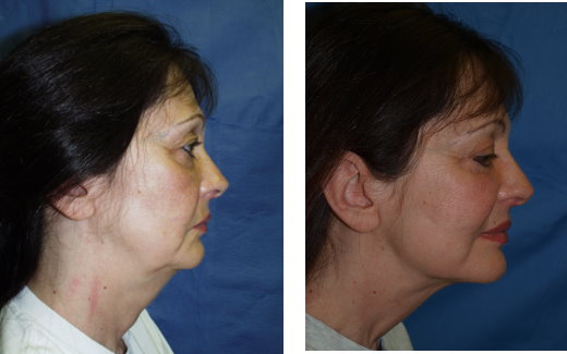 Neck Lift ( before & after)
