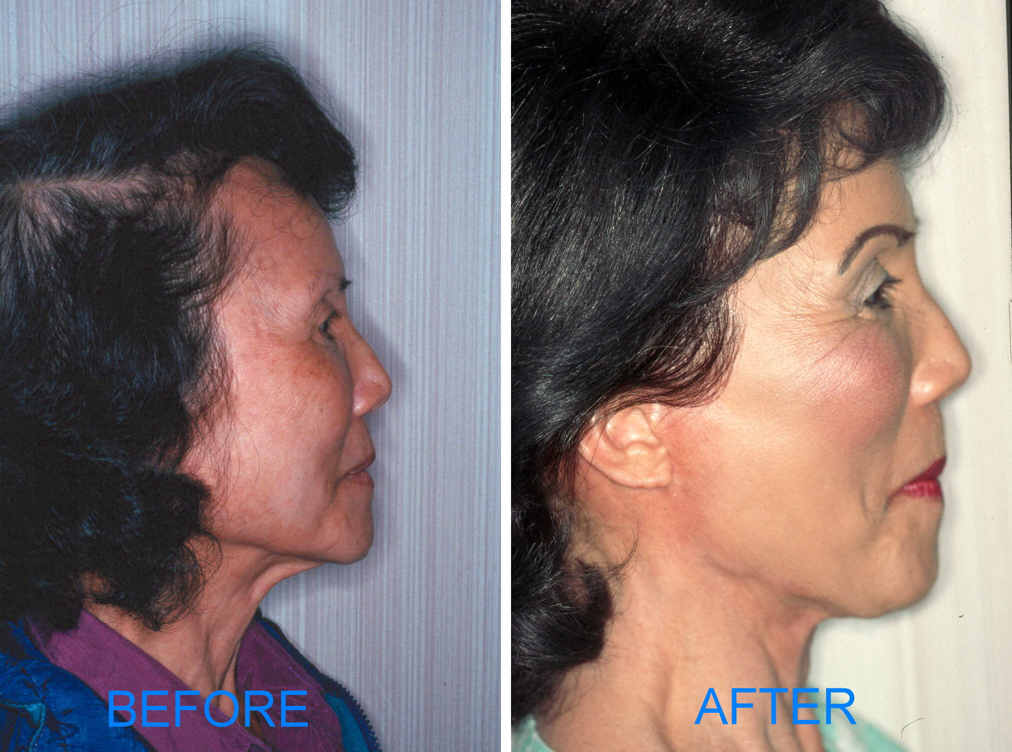 Facelift (Before & After- Lateral)