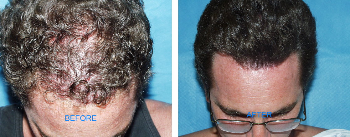 Follicular Unit Hair Transplants (Before & After)