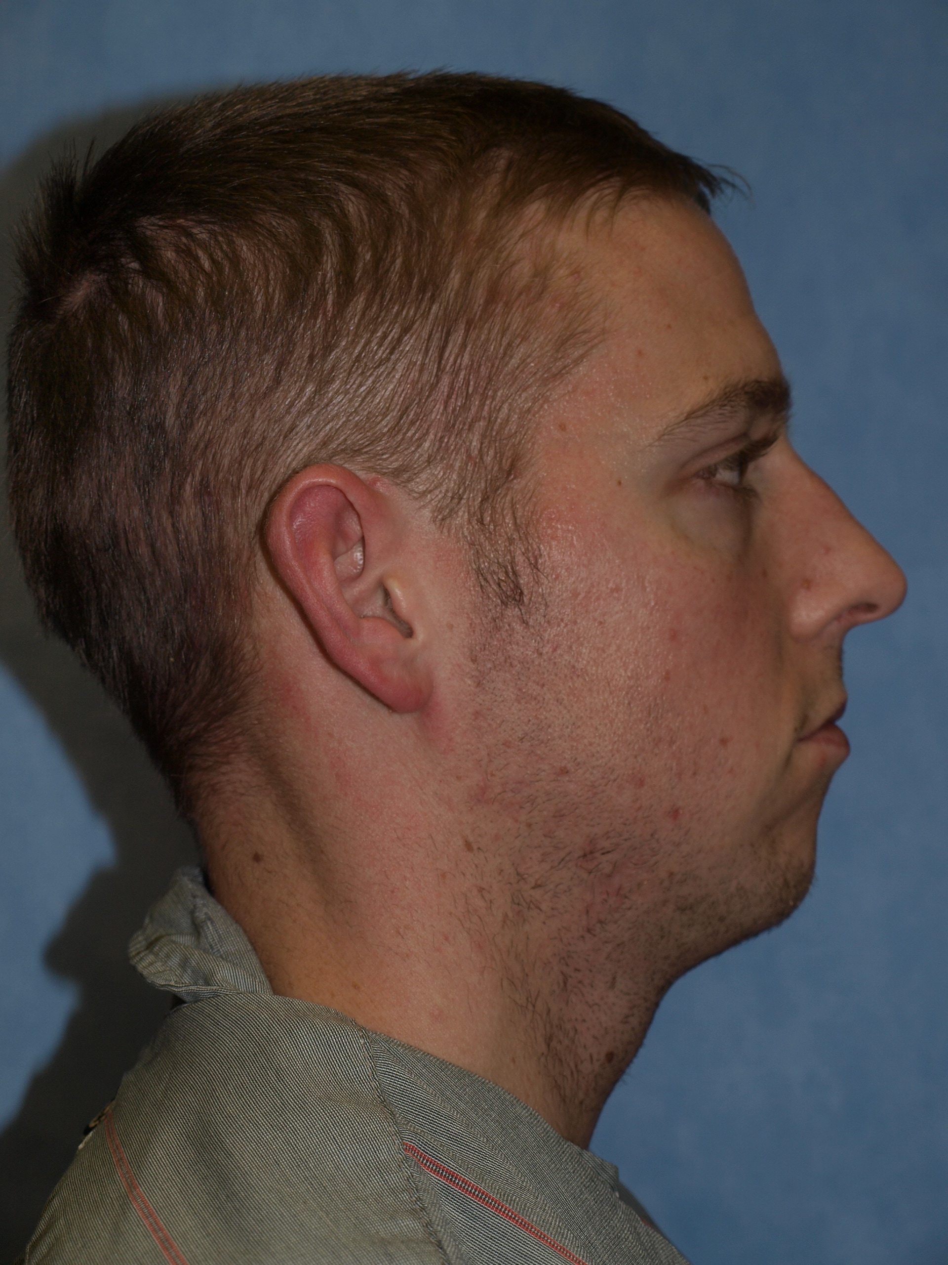Chin Implant (Lateral, Before)